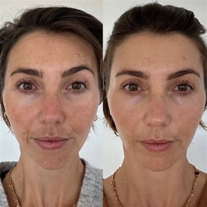 How do you get rid of hyperpigmentation after microneedling?
