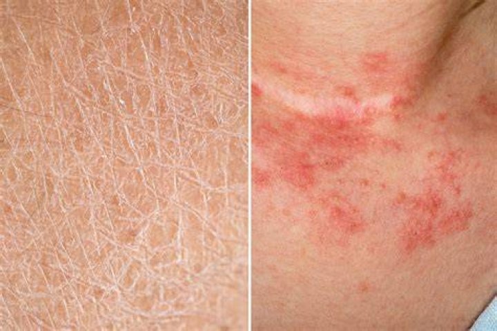 Should a rash be kept dry or moist?