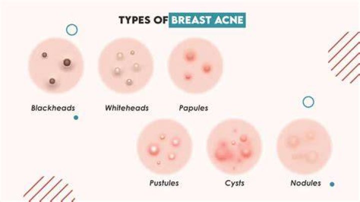 What does white dots on your nipples mean?