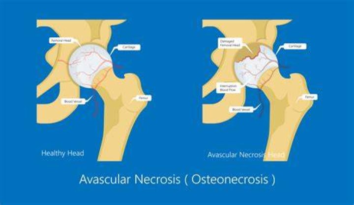 What happens if avascular necrosis is left untreated?