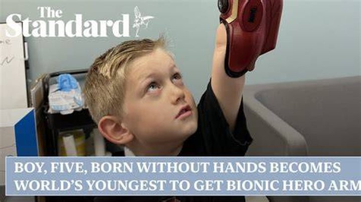 What is it called when you are born without a hand?