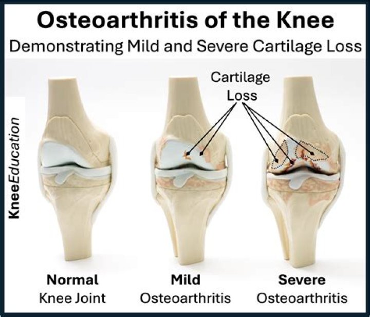 Will running make osteoarthritis worse?